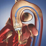 Hardened Aortic Valves