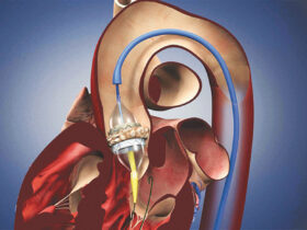Hardened Aortic Valves
