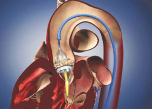 Hardened Aortic Valves