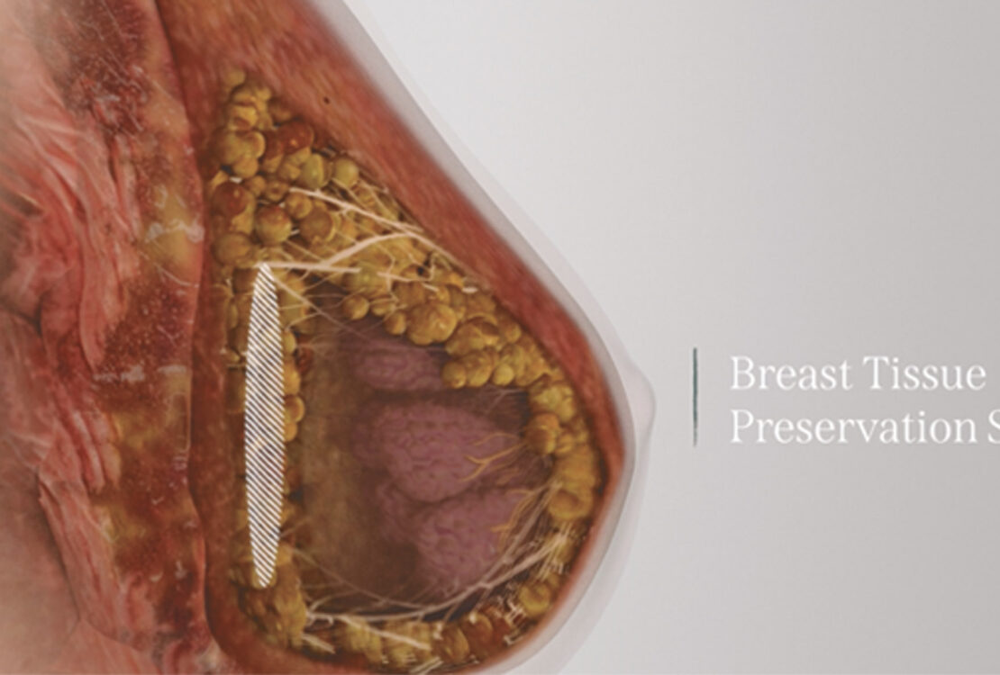 Preservé Breast Augmentation