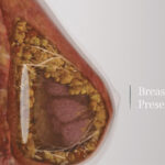 Preservé Breast Augmentation