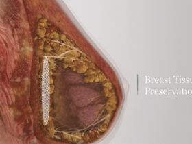 Preservé Breast Augmentation