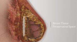 Preservé Breast Augmentation