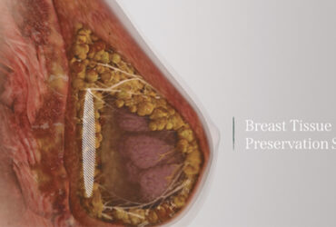 Preservé Breast Augmentation