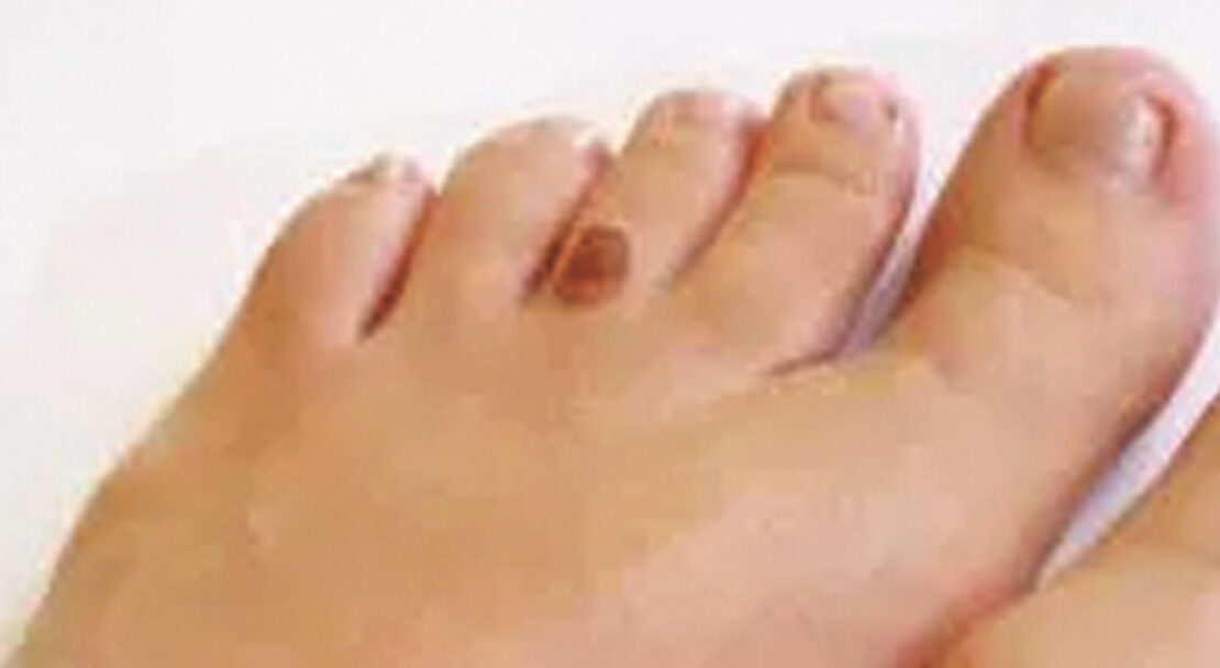 Skin Cancer Below the Knee