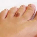 Skin Cancer Below the Knee