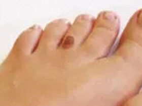 Skin Cancer Below the Knee