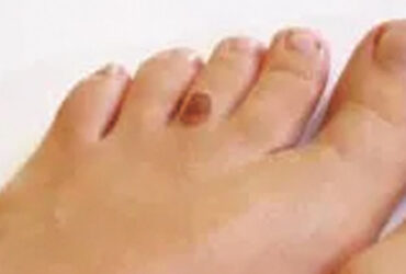 Skin Cancer Below the Knee