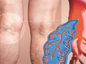 Venous Insufficiency