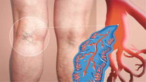 Venous Insufficiency