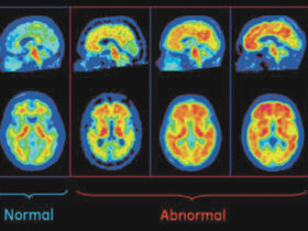 Alzheimer’s Disease