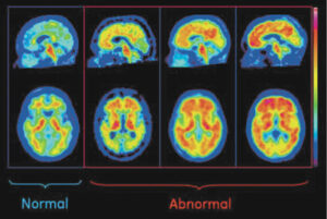 Alzheimer’s Disease