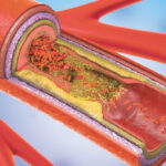 Carotid Disease