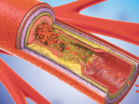 Carotid Disease