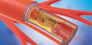 Carotid Disease