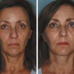 Deep Plane Facelift: