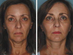 Deep Plane Facelift:
