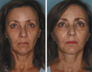 Deep Plane Facelift: