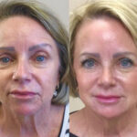 European Liquid Facelift