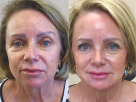 European Liquid Facelift