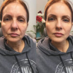 European Liquid Facelift