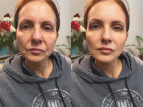 European Liquid Facelift