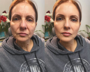 European Liquid Facelift