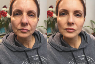 European Liquid Facelift
