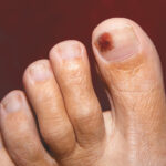 Melanoma Under the Nail