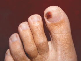 Melanoma Under the Nail