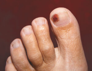 Melanoma Under the Nail