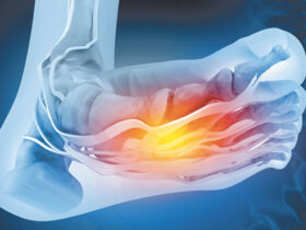 Reclaiming Your Feet from Neuropathy