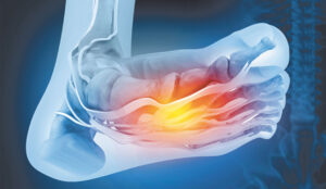 Reclaiming Your Feet from Neuropathy