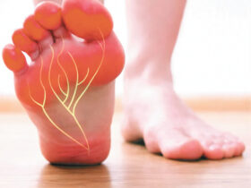 Relief From Nerve Pain