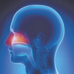 Sinusitis