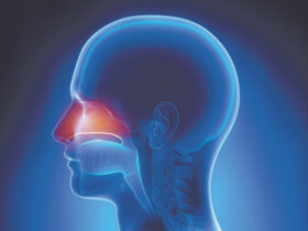 Sinusitis