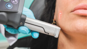 CoolPeel CO2 Laser