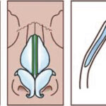 Nasal Obstruction