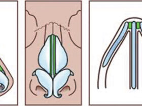 Nasal Obstruction