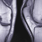Joint Injuries