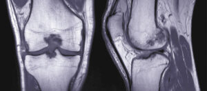 Joint Injuries